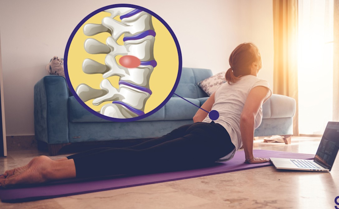 فیزیوتراپی برای کمردرد و دیسک کمر – درمانی موثر بدون جراحی